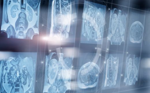AI ChatGPT and radiology image