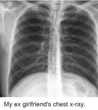 x-ray-joke-my-ex-girlfriend-339x382.jpg