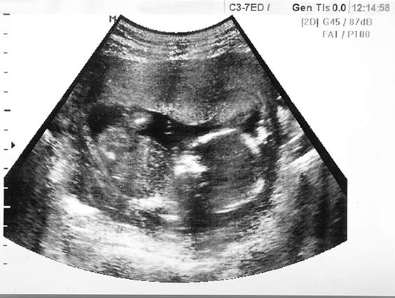 Early ultrasound image showing the introduction of 'real-time' ultrasound technology.