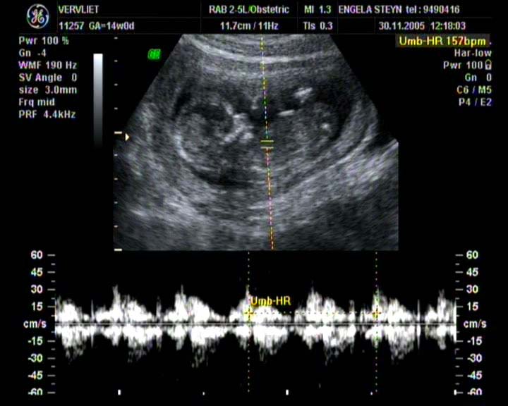 Ultrasound image showing a fetus, highlighting the routine use of ultrasound in monitoring pregnancy.