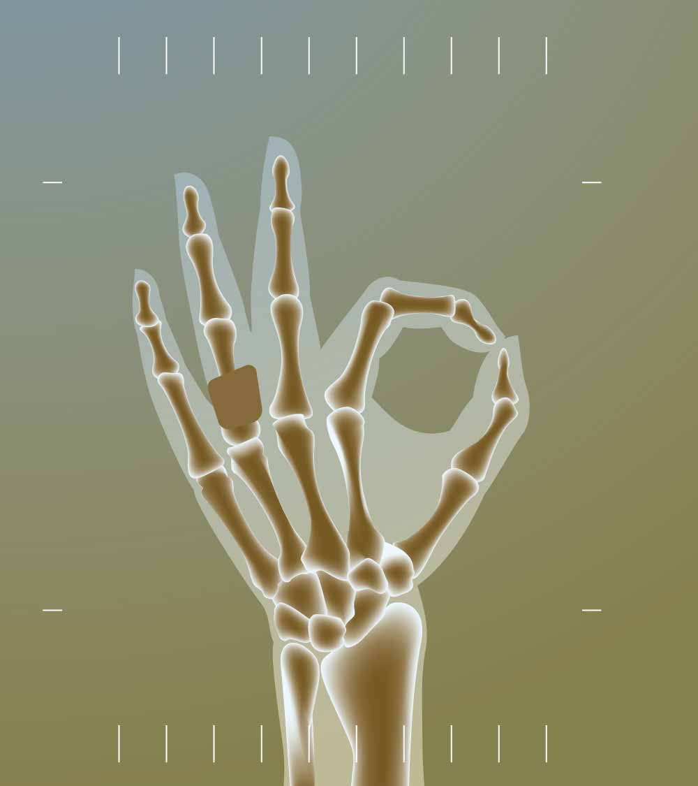 X-ray of a hand making an 'OK' sign, showing skeletal details and a bone fracture.