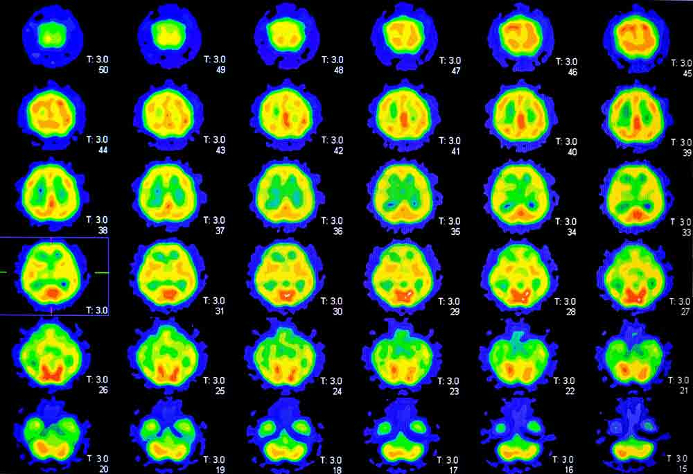 Series of brain images from the first functional MRI (fMRI) conducted by Belliveau et al.