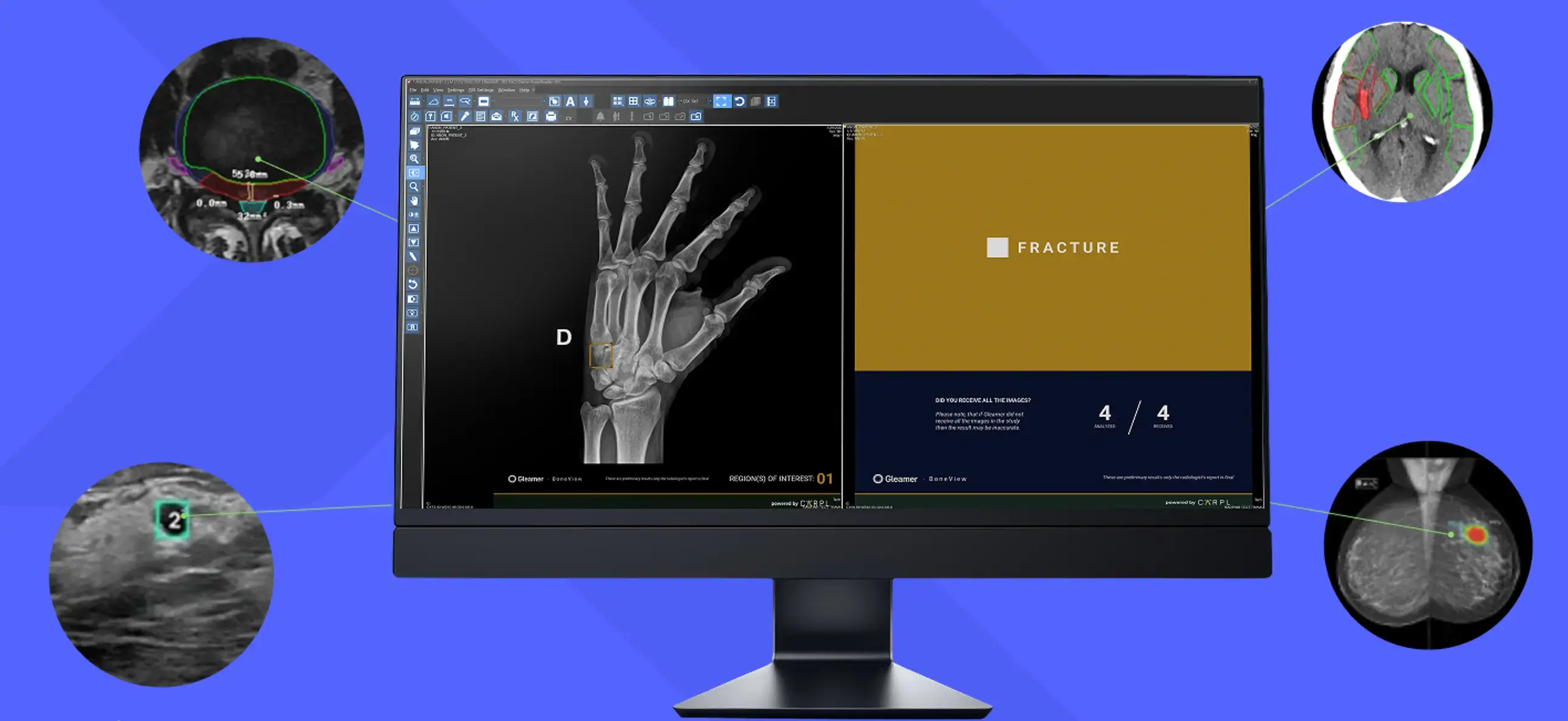 Radiology automation tool detecting hand fracture in X-ray with AI and multi-modality image overlay.