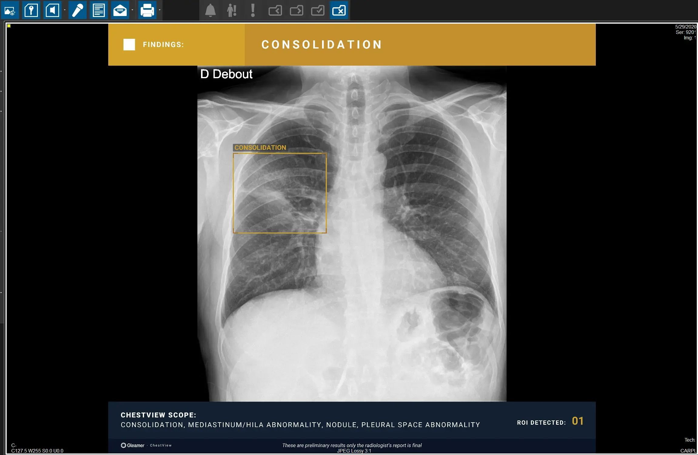 Chest X-ray with AI-detected consolidation showing radiology automation in abnormality detection.