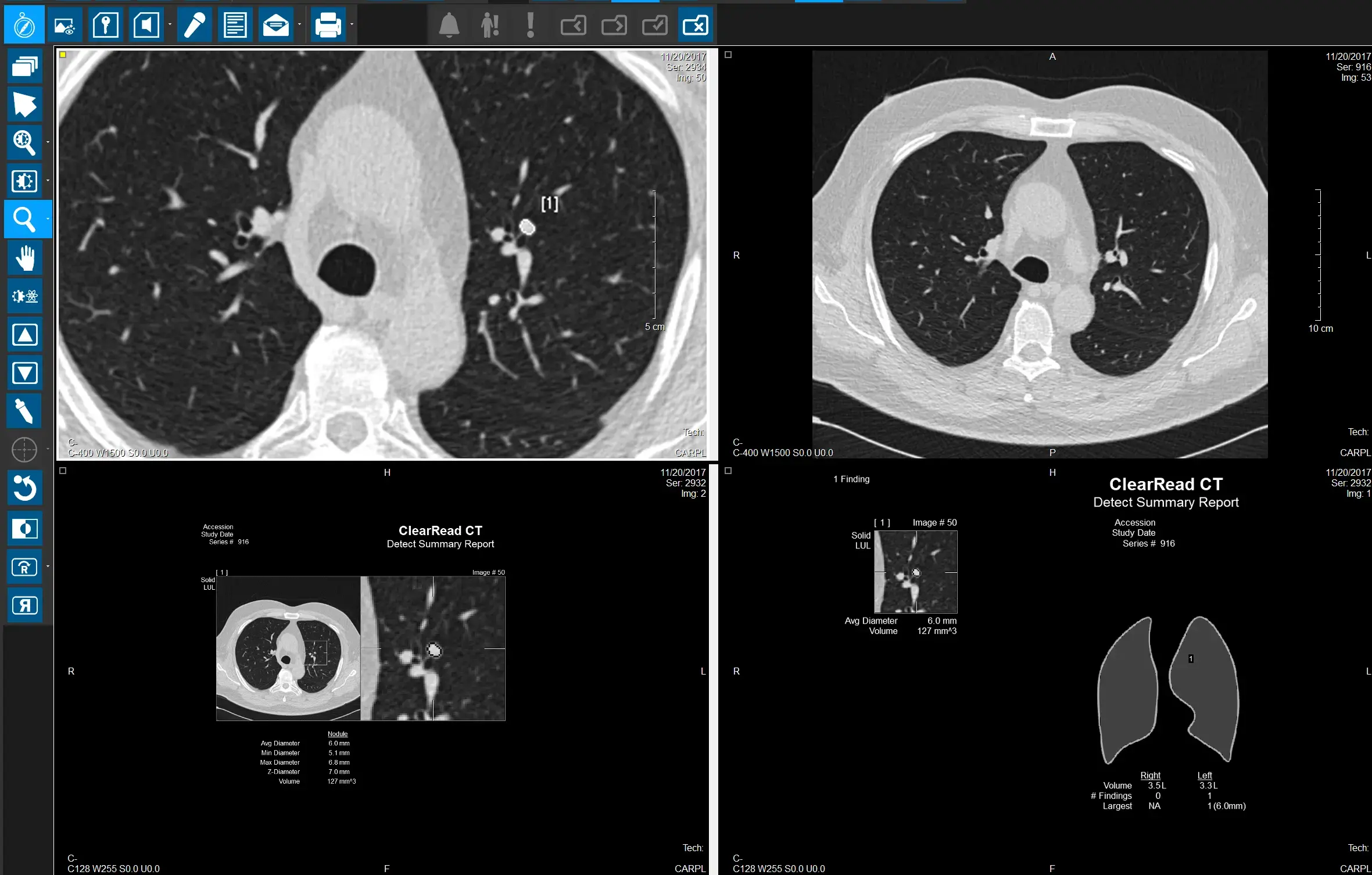 Lung CT scan using radiology automation to detect a pulmonary nodule with AI-measured dimensions.