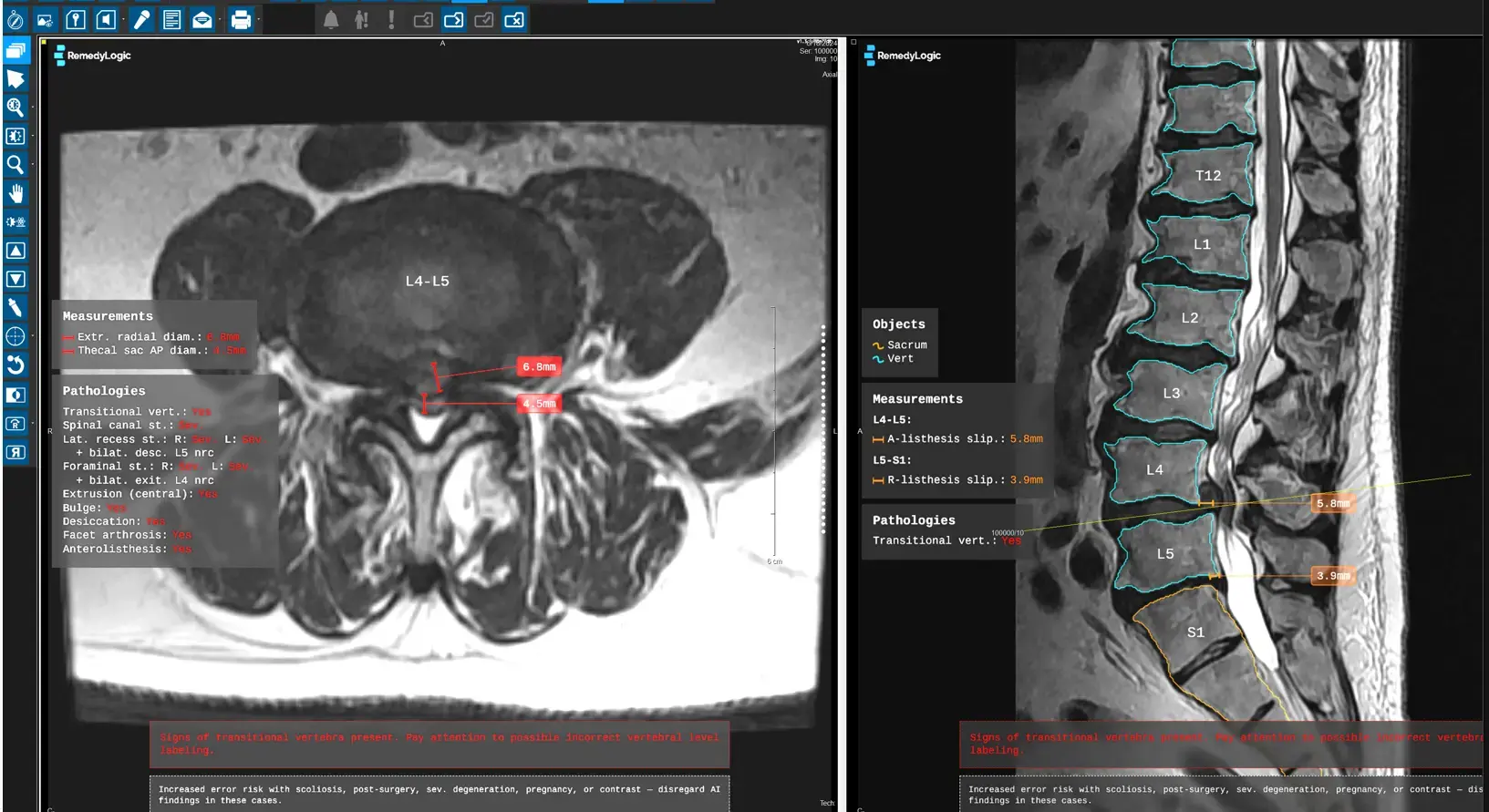 Spine MRI showing radiology automation with AI-generated vertebrae labels and pathology findings.
